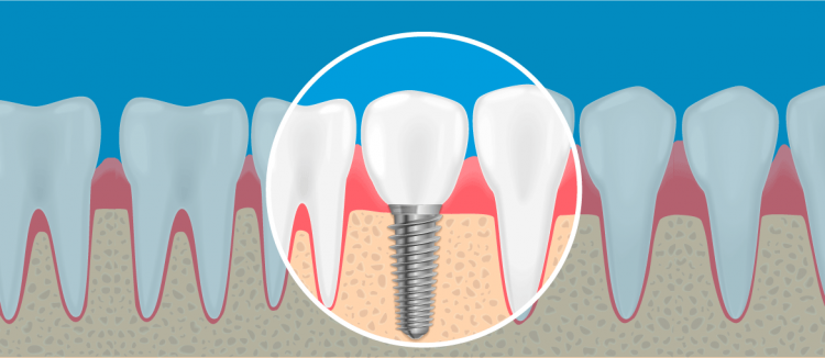 Você sabe como funciona o implante dentário?