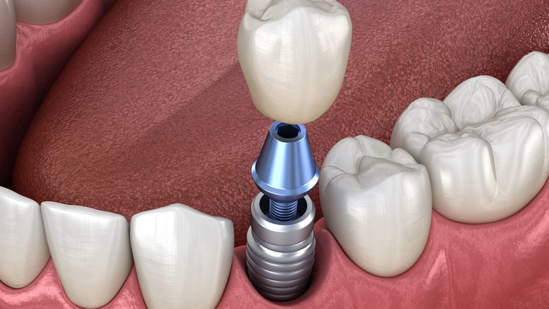 05 motivos para não adiar seu implante dentário