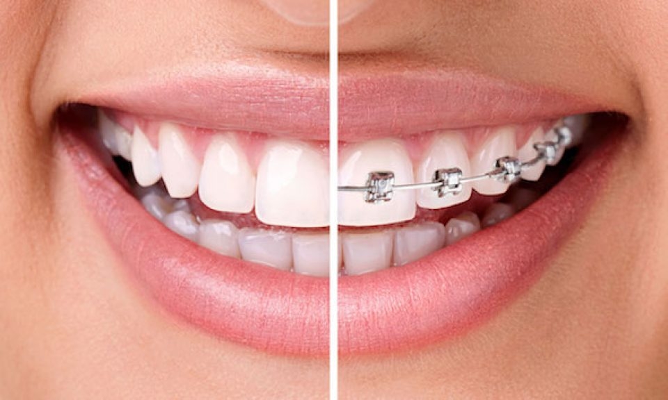 Aparelho ortodôntico e seus benefícios: dentes alinhados e autoestima